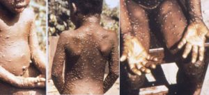 WHO, 유럽에서 원두 사례 100건 넘어가자 긴급 회의를 소집